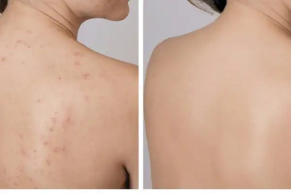 Lợi ích của trị mụn lưng