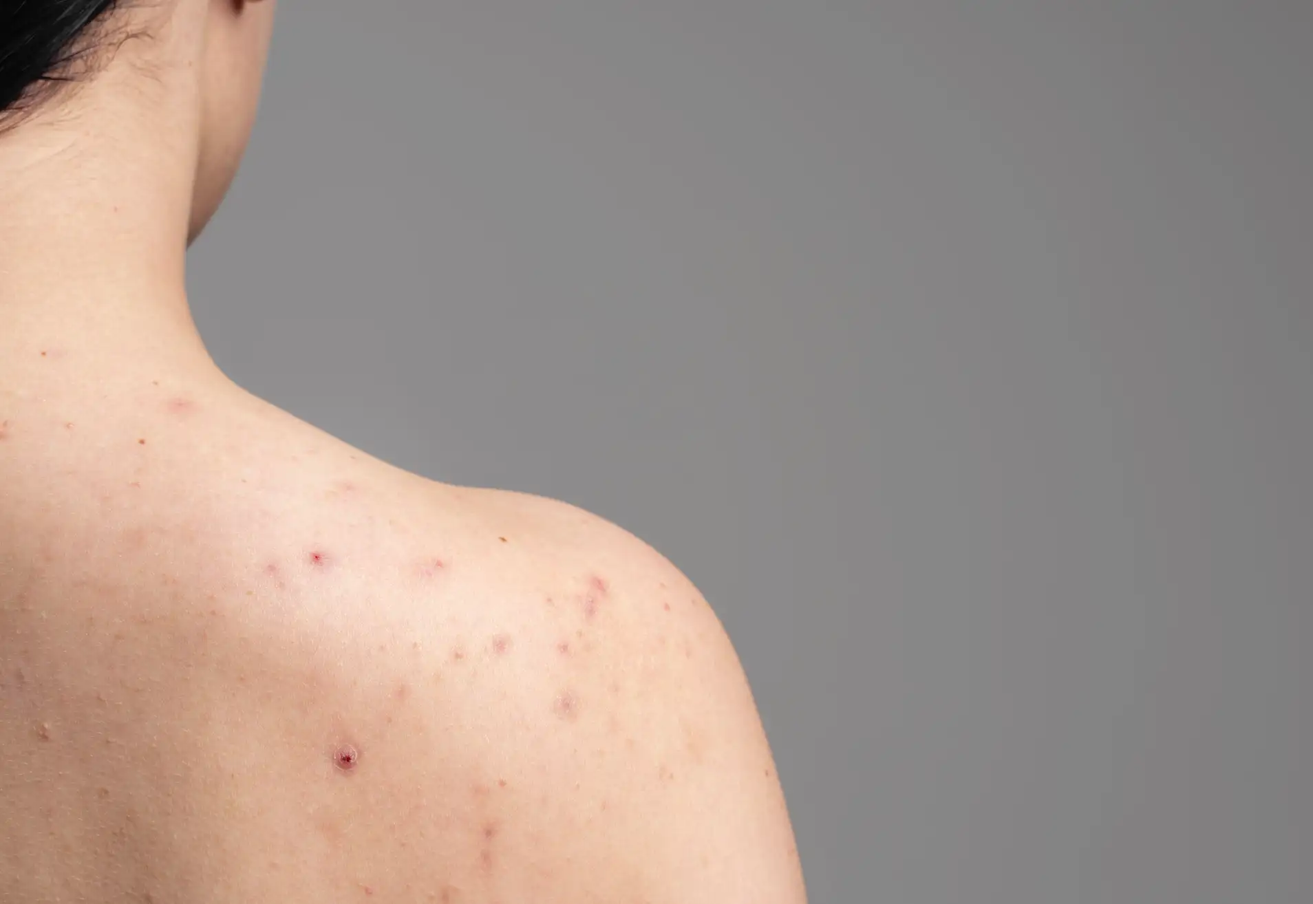 Trị mụn lưng hiệu quả