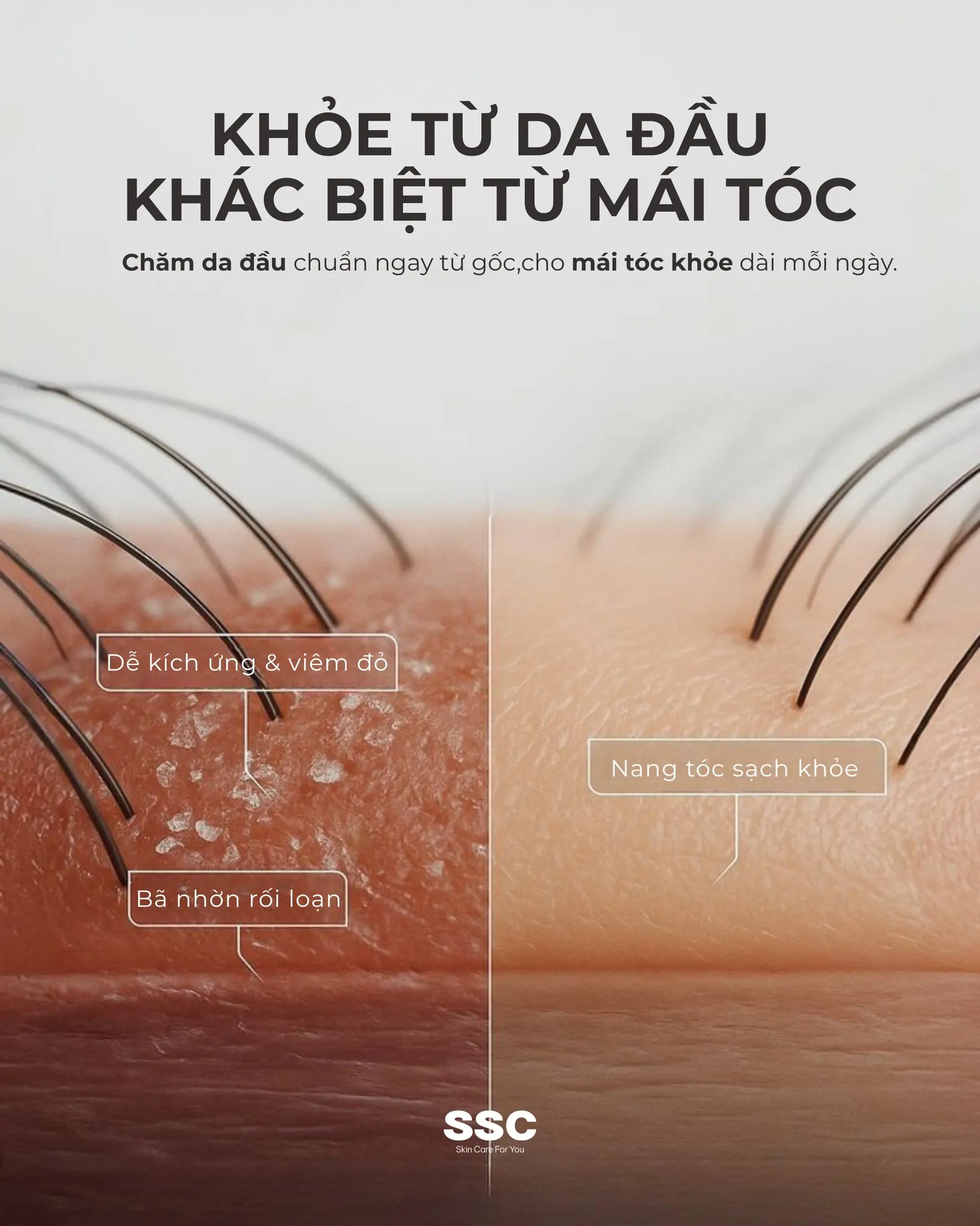 Bạn có biết? 80% vấn đề của tóc bắt nguồn từ da đầu